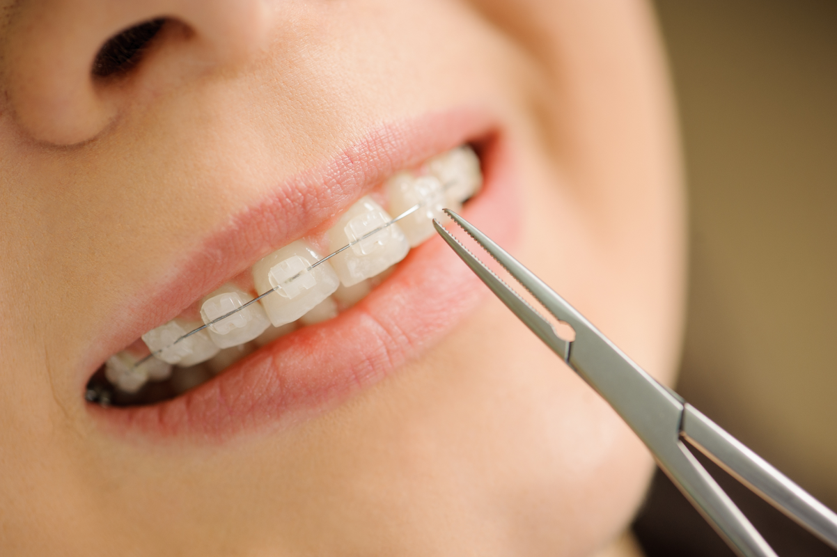 adobestock Incidents en orthodontie Drs Haïm - Orthodontistes à Paris 15