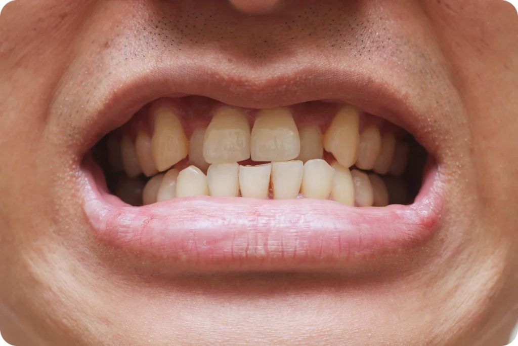 chauvement dentaire paris Orthodontie adulte Drs Haïm - Orthodontistes à Paris 15