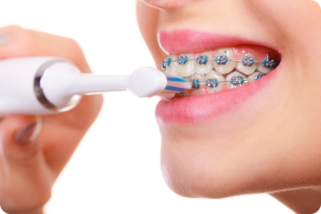 orthodontiste adolesceent aligneurs bagues brossage Orthodontie adolescent Drs Haïm - Orthodontistes à Paris 15