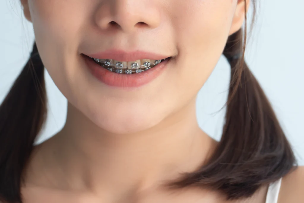 paris consultation orthodontiste bagues Orthodontie enfant Drs Haïm - Orthodontistes à Paris 15