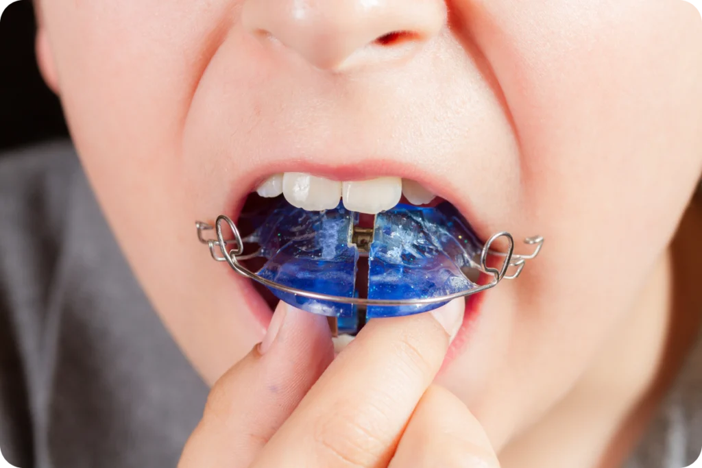 paris consultation orthodontiste plaque palatine Nos conseils Drs Haïm - Orthodontistes à Paris 15