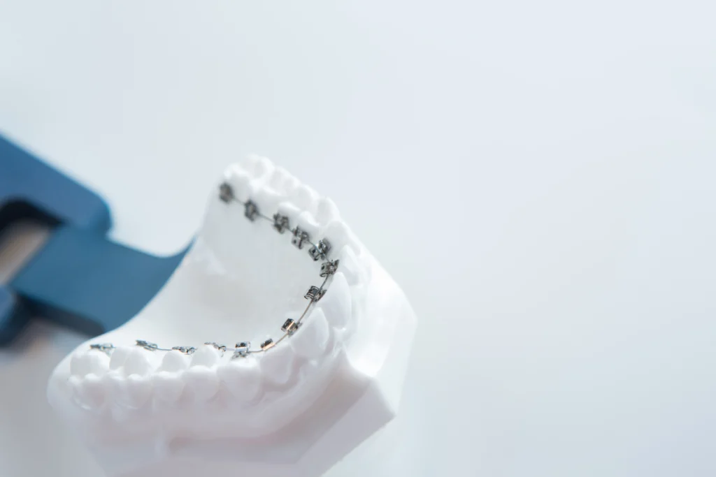 adobestock Appareil lingual Drs Haïm - Orthodontistes à Paris 15
