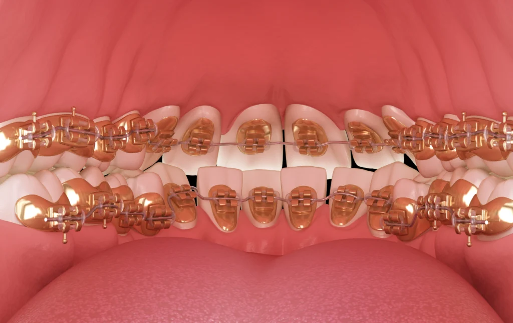 adobestock Appareil lingual Drs Haïm - Orthodontistes à Paris 15