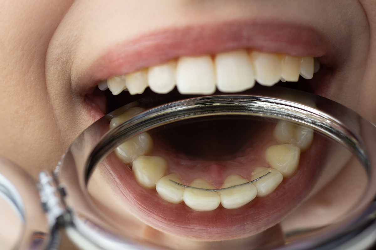 contention Parcours de soins Drs Haïm - Orthodontistes à Paris 15